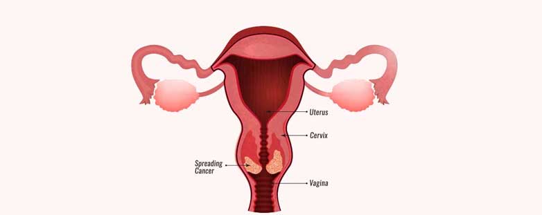 Cancer Screening